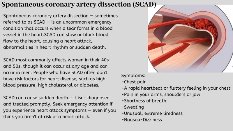Rising concern of SCAD recurrence in patients