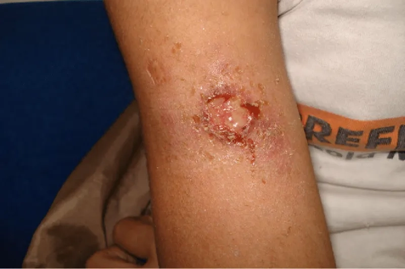 A box of Itraconazole for sporotrichosis