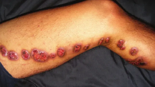 A person's hand with lesions from rose gardener's disease