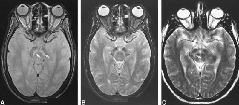 Recognizing St. Louis encephalitis symptoms early