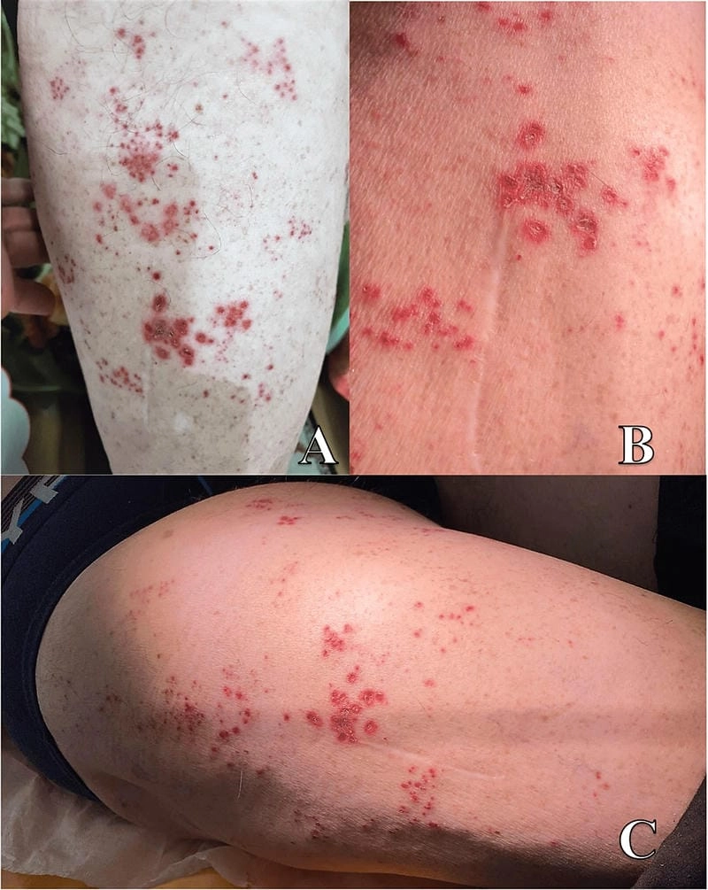 Key steps in the diagnosis of St. Louis encephalitis