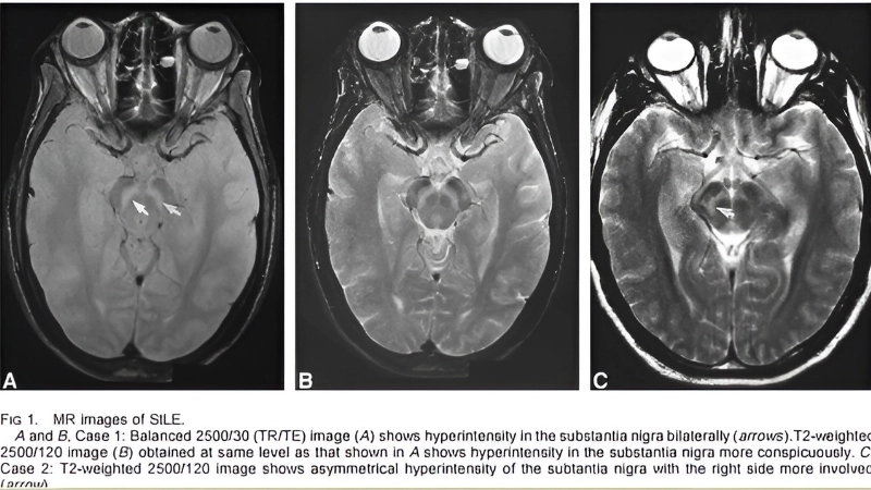 Compare St. Louis encephalitis vs West Nile virus clearly