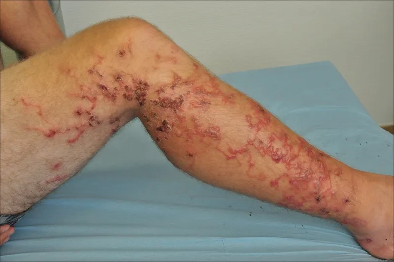 Visual guide explaining how do you get MRSA