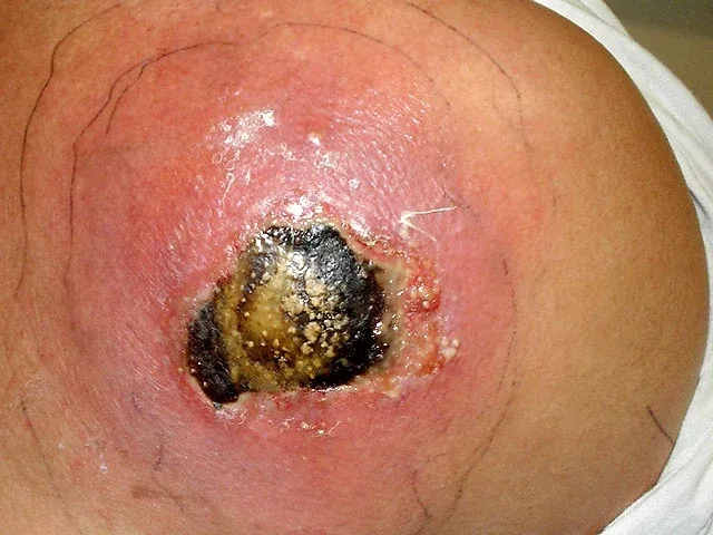 Clinical photograph of a characteristic MRSA rash