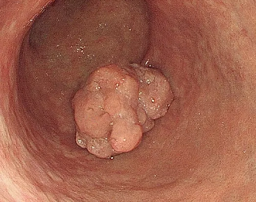 Awareness of gastric cancer risks and prevention