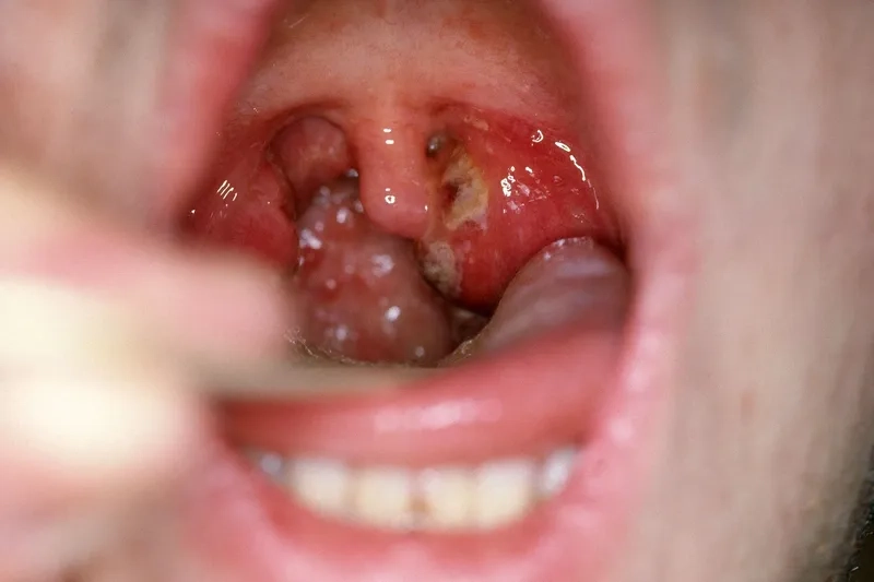 The Centor streptococcal pharyngitis criteria
