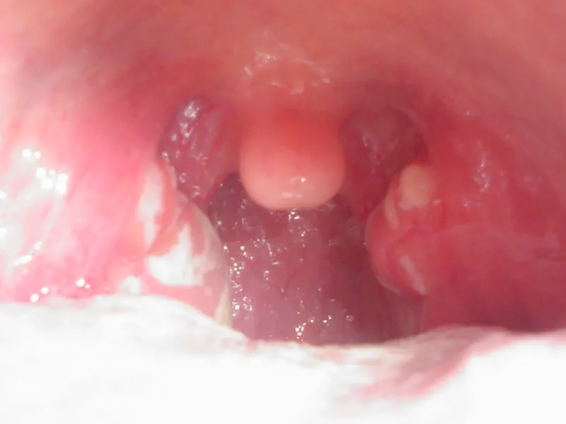 Standard treatment of streptococcal pharyngitis