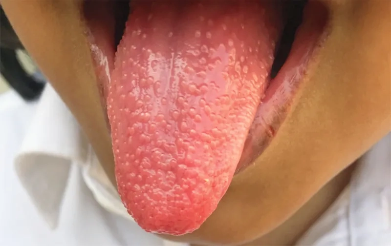 Finding the ICD 10 code for streptococcal pharyngitis