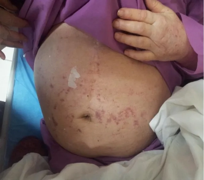 A medical chart explaining what is strongyloidiasis