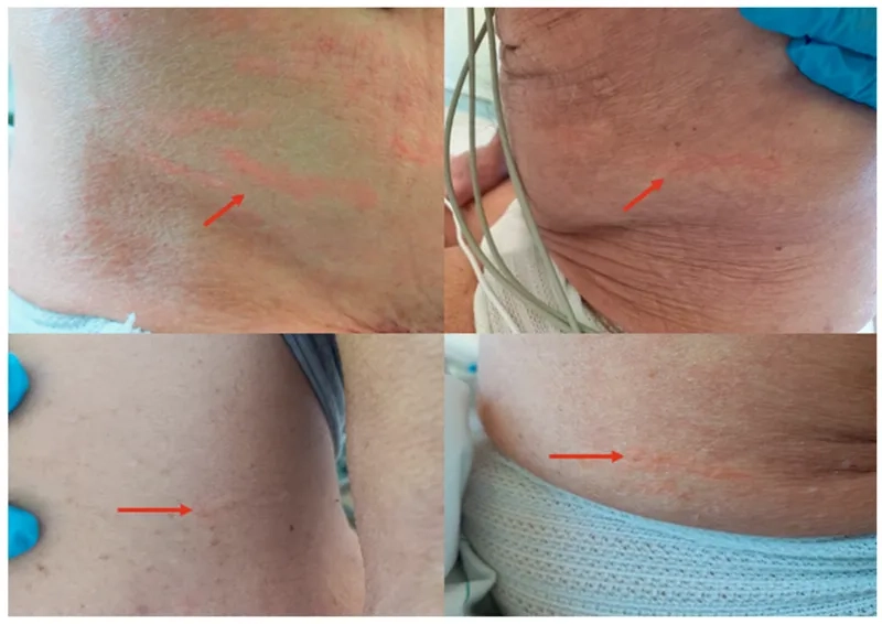 The roundworm Strongyloides stercoralis under a microscope