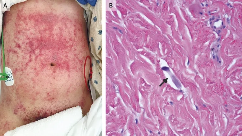 Medical chart showing hyperinfection syndrome progression