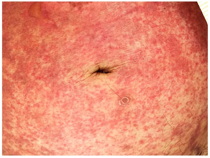 The impact of a chronic threadworm infection on the body