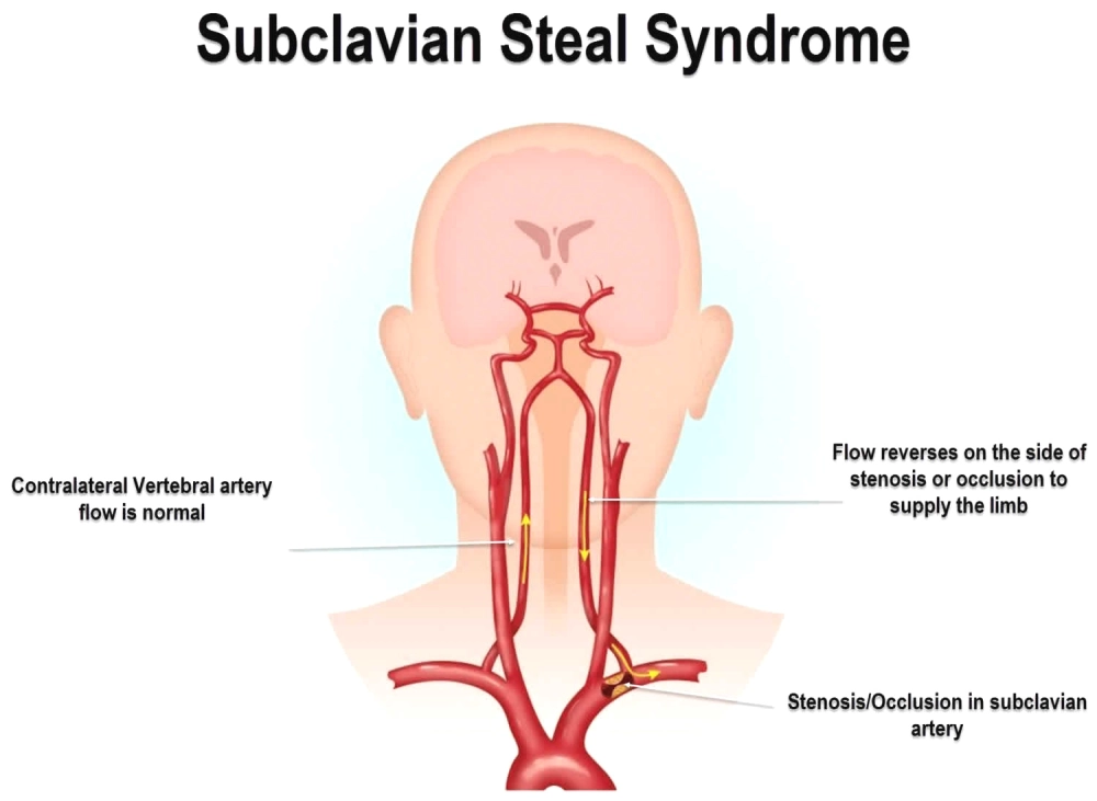 Congestive heart failure affecting daily life deeply