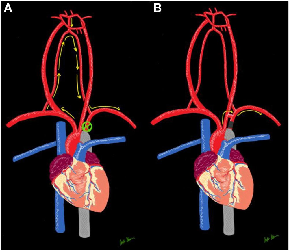 Cardiomyopathy and the weakening of heart muscle