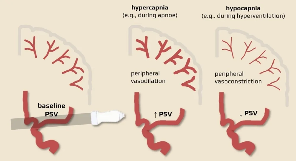 Atherosclerosis and its severe artery damage