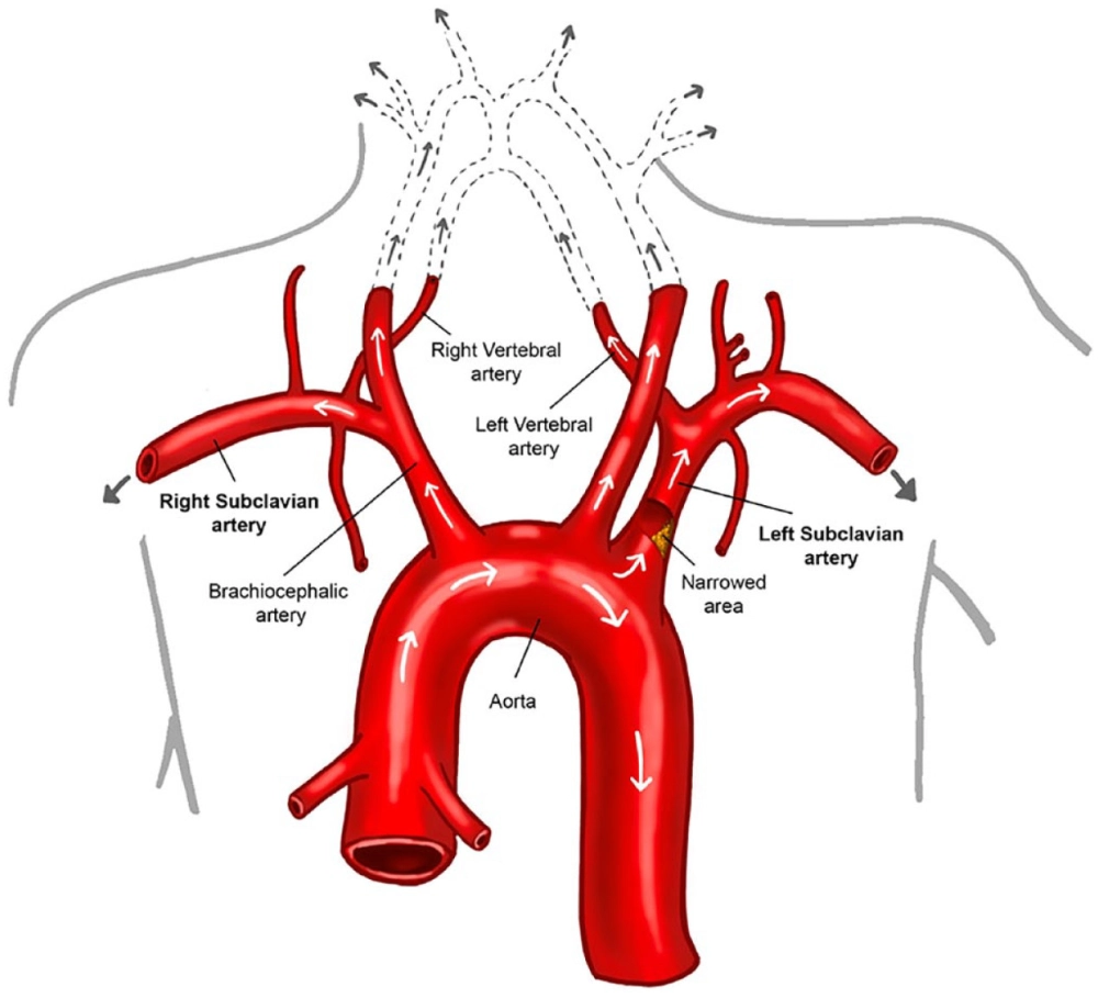 Stroke signs highlighted with early warning image