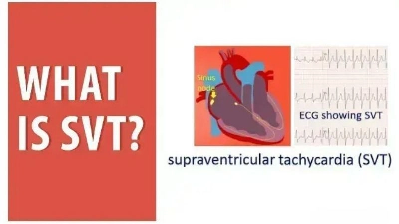 Supraventricular Tachycardia symptoms include rapid heartbeat spells