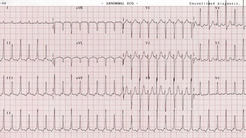 Supraventricular Tachycardia causes range from stress to heart disease