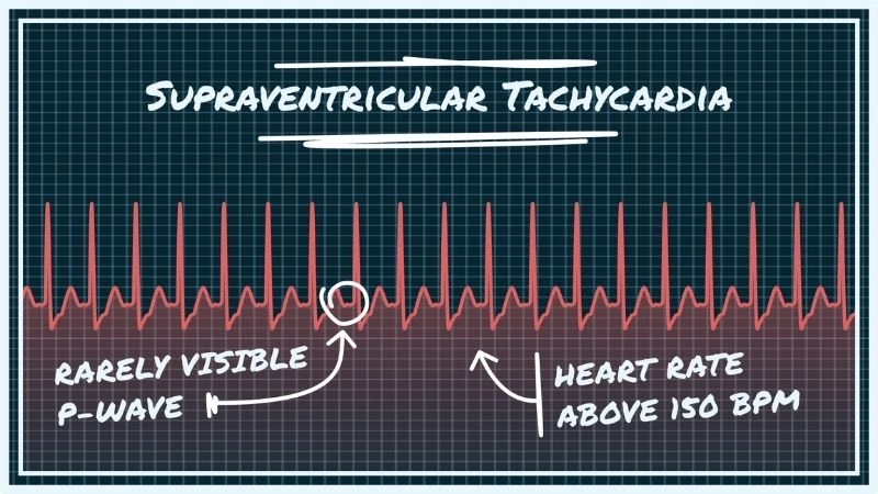 SVT heart palpitations create sudden racing and pounding sensations