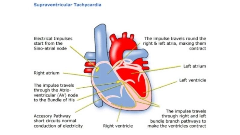 How to stop an SVT episode with simple vagal maneuvers