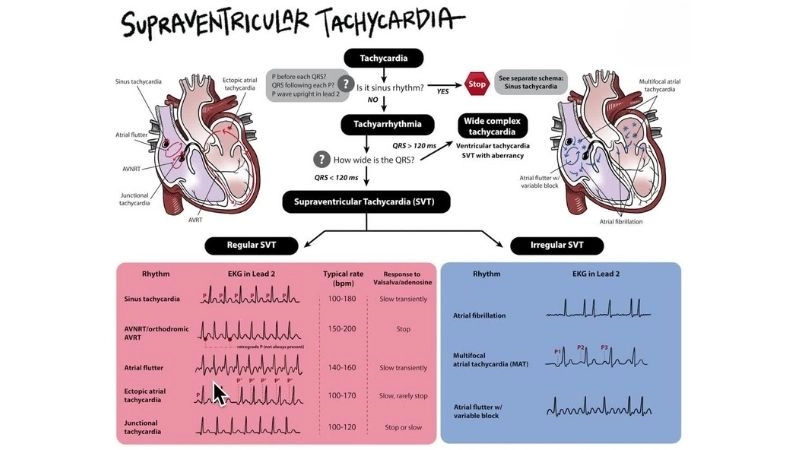 Supraventricular Tachycardia diagnosis confirmed through ECG monitoring