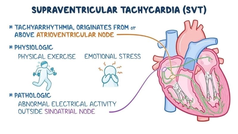 SVT ablation offers long term relief from recurrent episodes