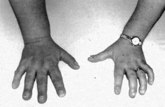 An illustration of the main causes of syringomyelia