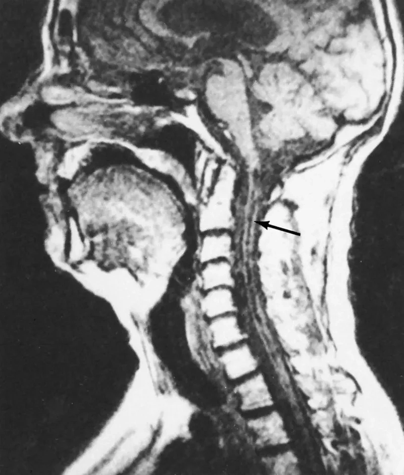 A diagram of a syringomyelia surgery procedure