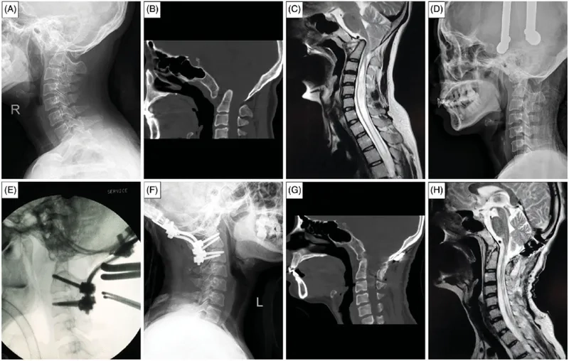 A patient consultation for syringomyelia symptoms