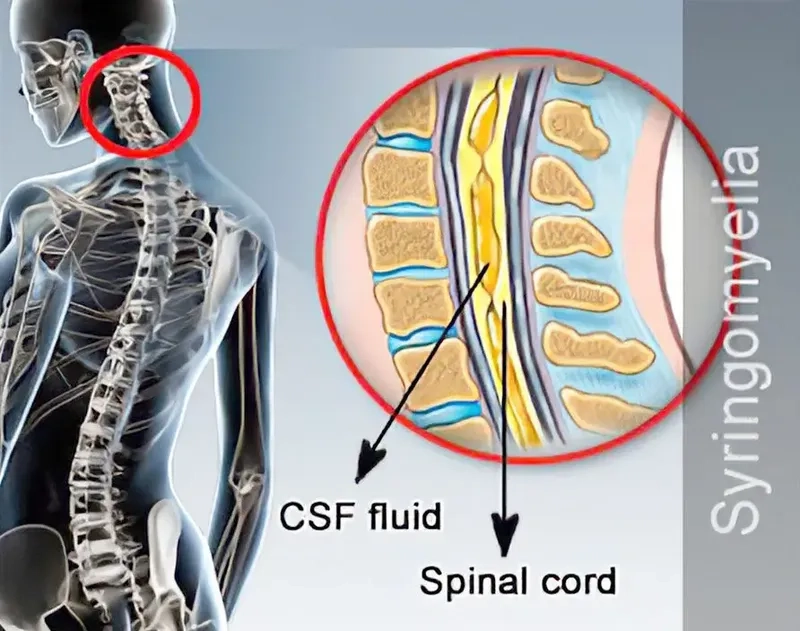 A chart listing common syringomyelia symptoms