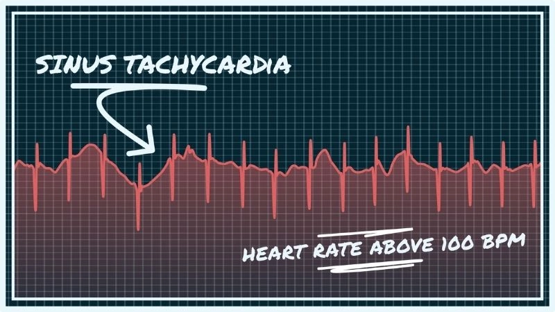 Tachycardia treatment restores normal heart rhythm safely