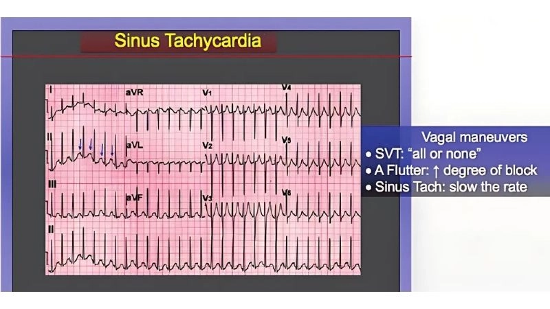 Causes of tachycardia include stress illness and heart problems