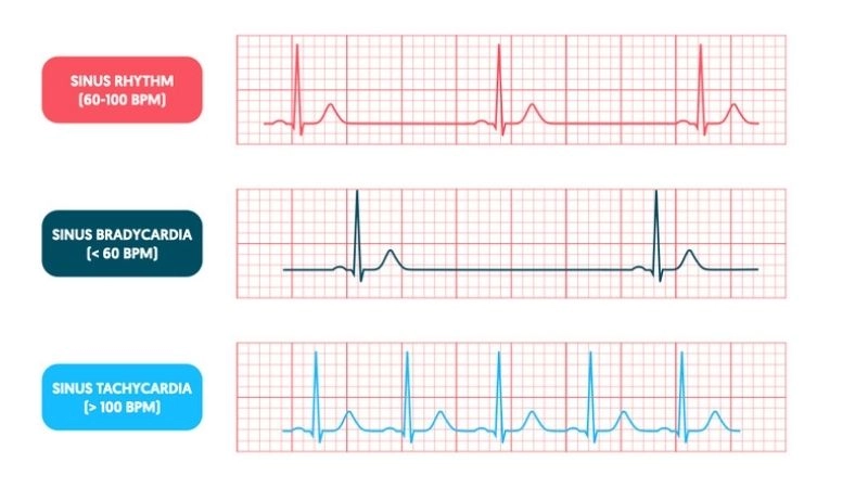 Symptoms of tachycardia include rapid heartbeat and dizziness