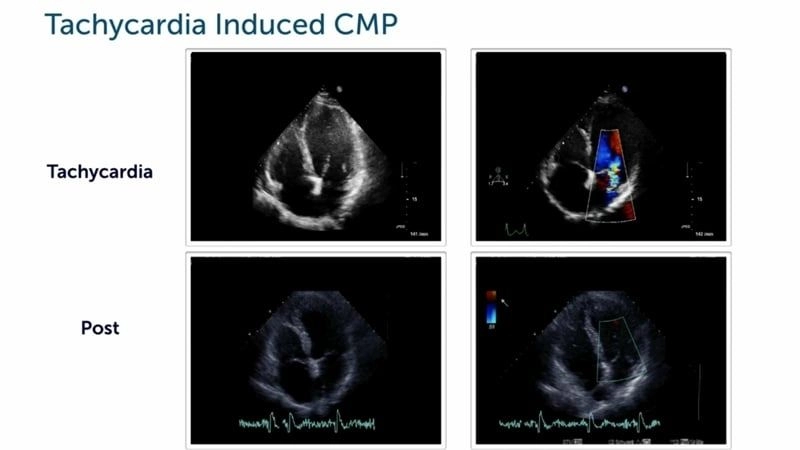 Tachycardia induced cardiomyopathy prognosis outlook for recovery