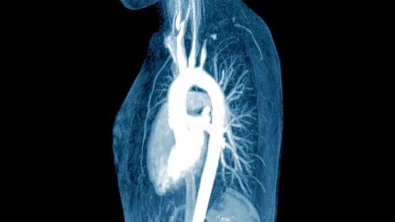 Takayasu's arteritis a rare disease of vessels