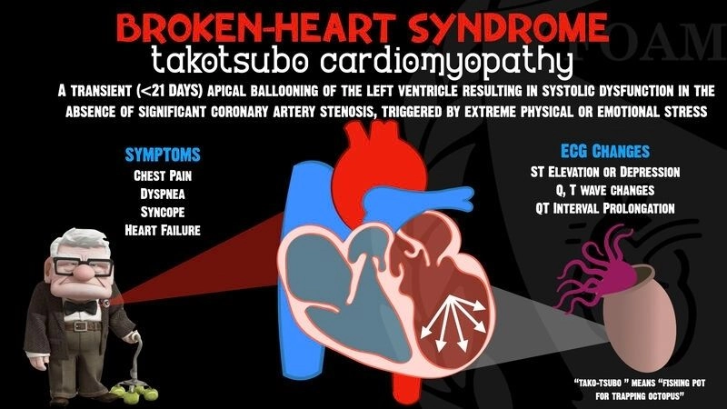 Takotsubo cardiomyopathy symptoms sudden heart stress signs