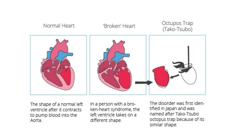 Takotsubo cardiomyopathy treatment ways to support recovery