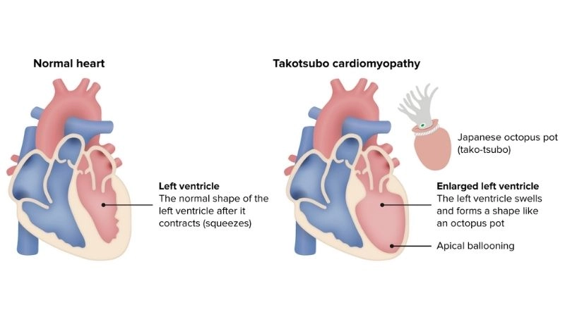 Takotsubo cardiomyopathy diagnosis early detection is vital