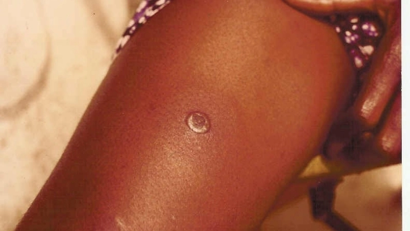 Accurate Tanapox diagnosis requires lab testing