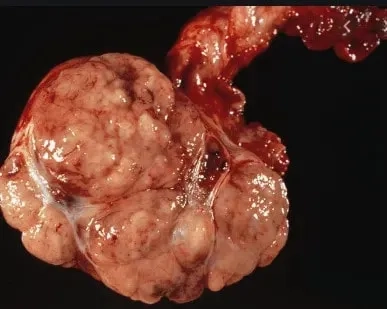Chart illustrating testicular cancer survival rate
