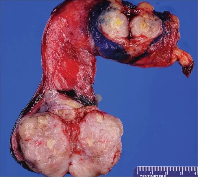 Medical image of a lump on testicle