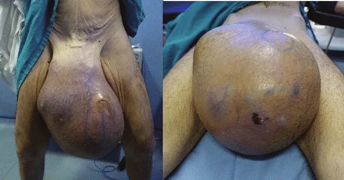 Diagram showing testicular cancer stages