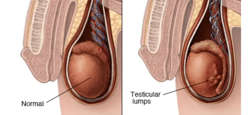 Recognizing common testicular cancer symptoms