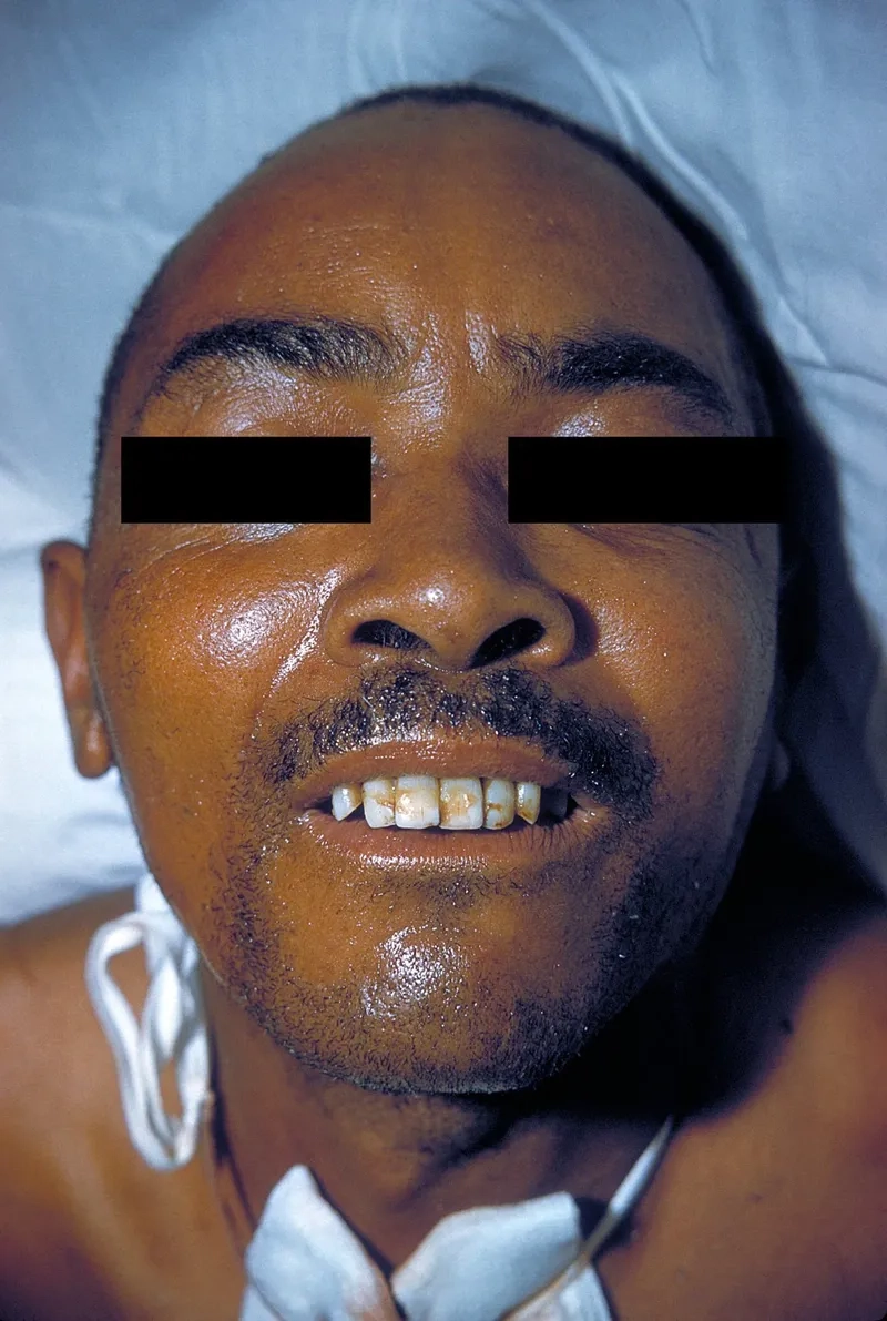 Recognizing the key tetanus symptoms early