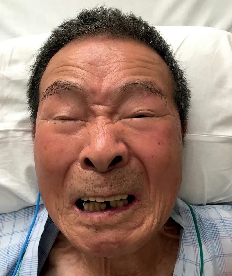 The tetanus vaccine (DTaP, Tdap) vial and syringe