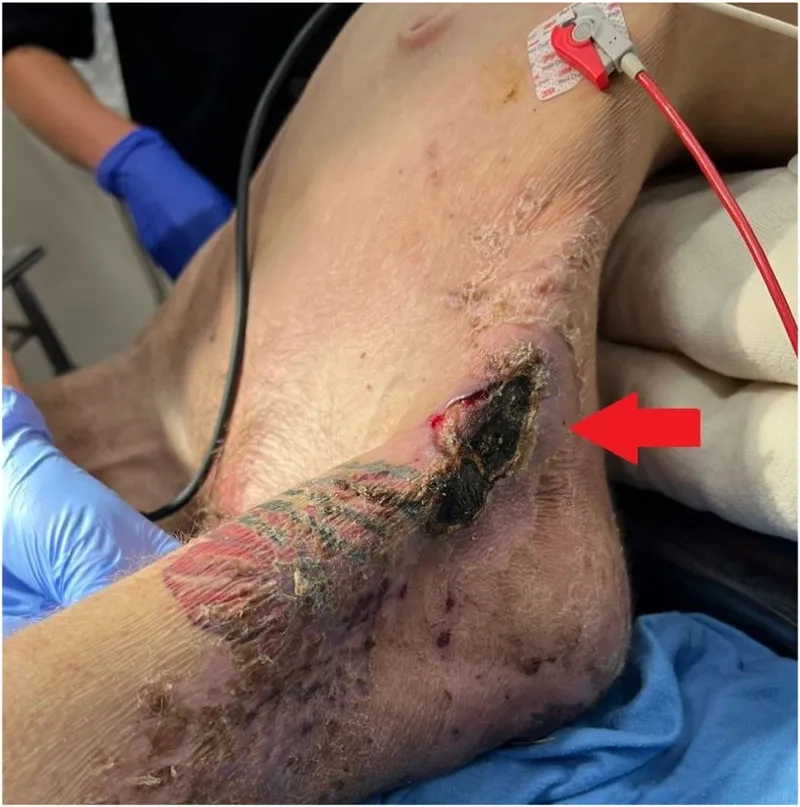 How often do you need a tetanus shot: a guide