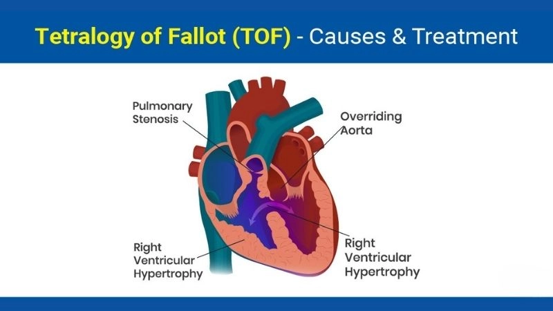 Tetralogy of Fallot symptoms early signs of cyanotic heart defect