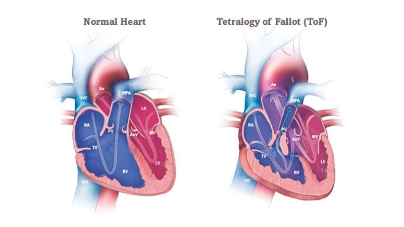 Tetralogy of Fallot prognosis outlook after timely surgery