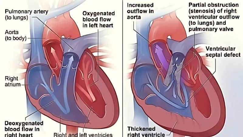 Living with tetralogy of Fallot long term heart care