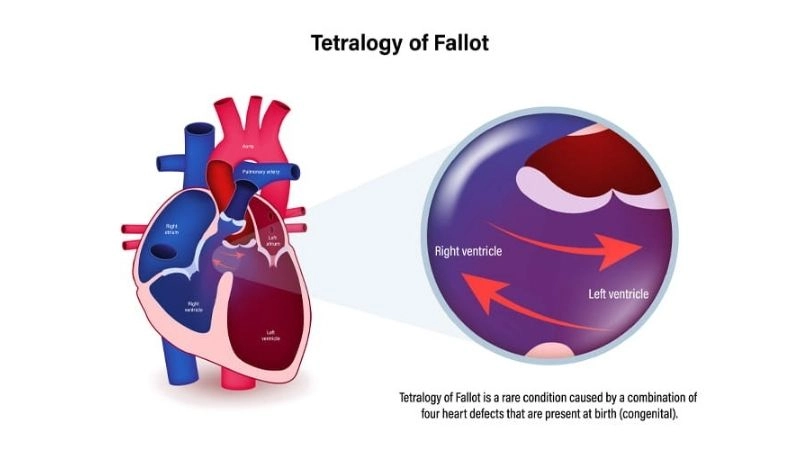 Tetralogy of Fallot in adults challenges of late diagnosis